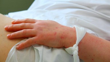 Europoje daugėja meningokokinės infekcijos atvejų: Prancūzija įvedė privalomą kūdikių skiepijimą